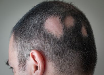 Kreisrunder Haarausfall